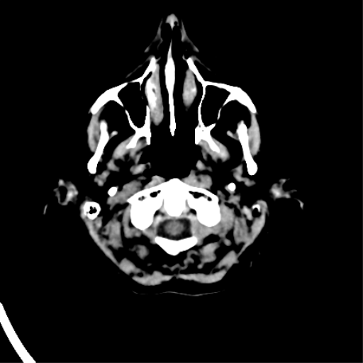 File:Cerebral arteriovenous malformation with lobar hemorrhage (Radiopaedia 44725-48510 Axial non-contrast 6).png