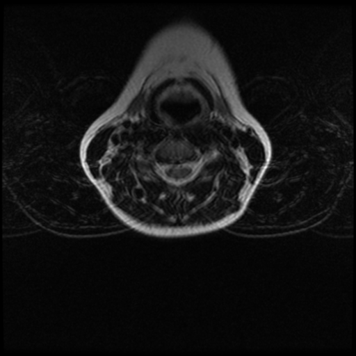 File:Cerebral autosomal dominant arteriopathy with subcortical infarcts and leukoencephalopathy (CADASIL) (Radiopaedia 41018-43763 Ax T2 C2-T1 12).png
