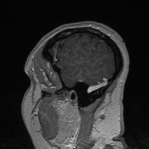 File:Cerebral cavernoma and development venous anomaly (Radiopaedia 37603-39482 Sagittal T1 C+ 16).png