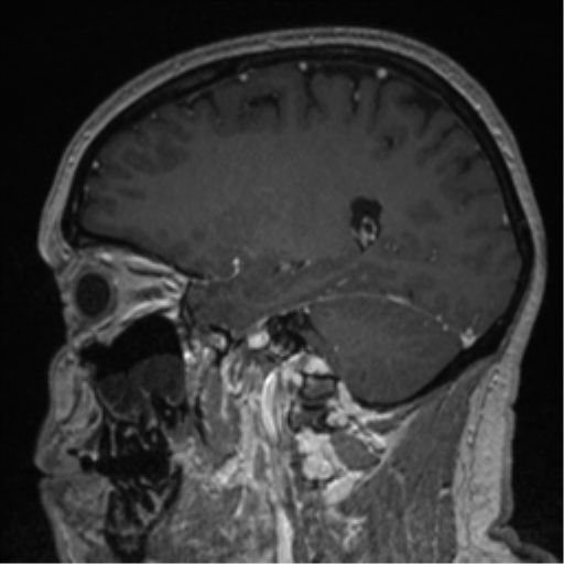 Cerebral cavernoma and development venous anomaly (Radiopaedia 37603-39482 Sagittal T1 C+ 62).png