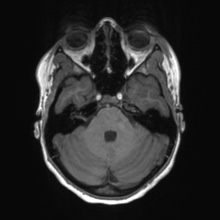 Cerebral cavernous venous malformation (Radiopaedia 70008-80021 Axial T1 18).jpg