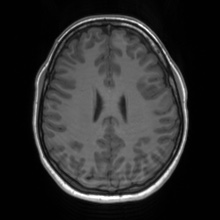 File:Cerebral cavernous venous malformation (Radiopaedia 70008-80021 Axial T1 50).jpg