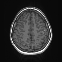 File:Cerebral cavernous venous malformation (Radiopaedia 70008-80021 Axial T1 66).jpg