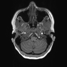 Cerebral cavernous venous malformation (Radiopaedia 70008-80021 Axial T1 8).jpg