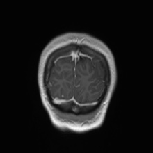 File:Cerebral cavernous venous malformation (Radiopaedia 70008-80021 Coronal T1 C+ 7).jpg