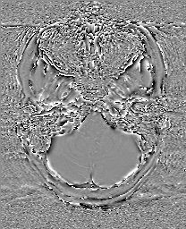 Cerebral cavernous venous malformation (Radiopaedia 70008-80021 G 10).jpg