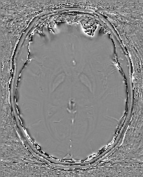 Cerebral cavernous venous malformation (Radiopaedia 70008-80021 G 36).jpg