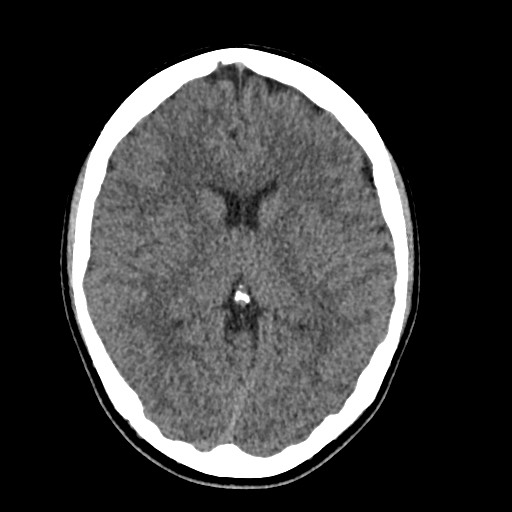 Cerebral cavernous venous malformation (Radiopaedia 70008-80022 Axial non-contrast 26).jpg