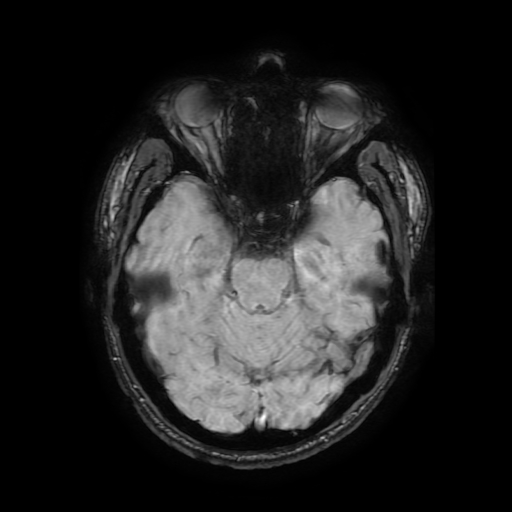 File:Cerebral cavernous venous malformation (Zabramski type II) (Radiopaedia 85511-101198 Axial SWI 49).jpg