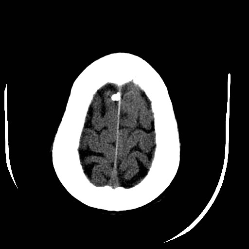 Cerebral edema (evolution in time) (Radiopaedia 19418-19440 non-contrast 83).jpg