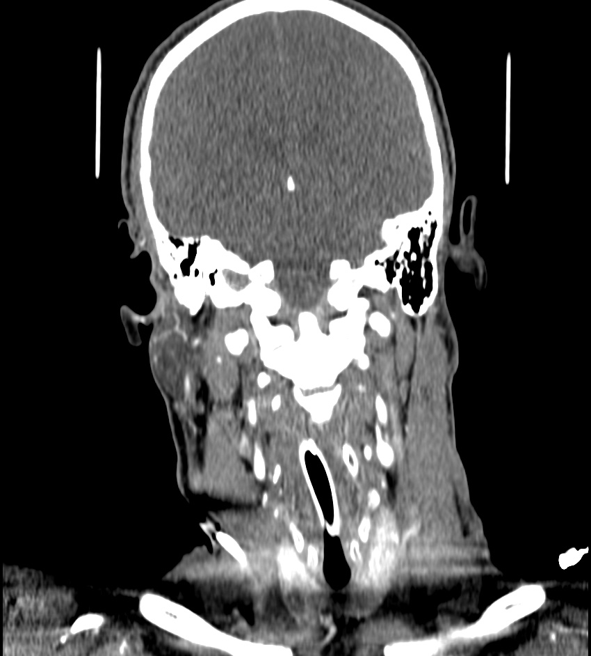 Cerebral edema in an overdose patient (Radiopaedia 72005-82539 B 83).jpg