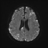 Cerebral embolic infarcts (embolic shower) (Radiopaedia 72391-82921 Axial DWI 49).jpg
