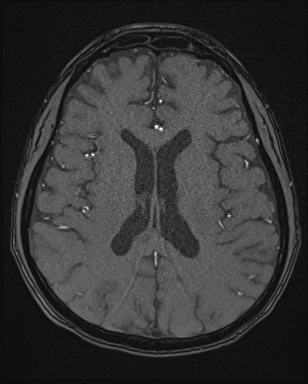 Cerebral embolic infarcts (embolic shower) (Radiopaedia 72391-82921 Axial MRA 115).jpg