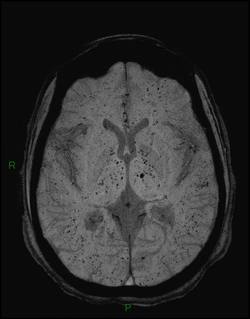File:Cerebral fat embolism (Radiopaedia 35022-36525 Axial SWI 18).jpg