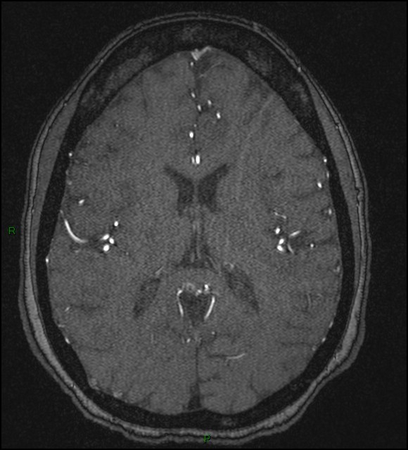 Cerebral fat embolism (Radiopaedia 35022-36525 Axial TOF 121).jpg