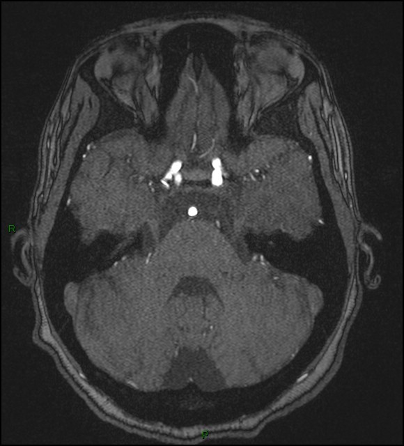 Cerebral fat embolism (Radiopaedia 35022-36525 Axial TOF 56).jpg