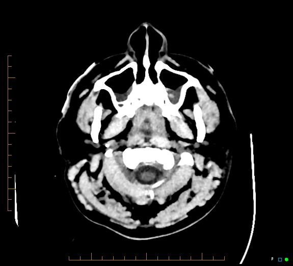 Cerebral fat embolism (Radiopaedia 85521-101220 Axial non-contrast 6).jpg