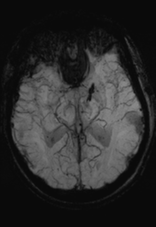 File:Cerebral hemorrhagic contusions- temporal evolution (Radiopaedia 40224-42757 Axial SWI 15).png