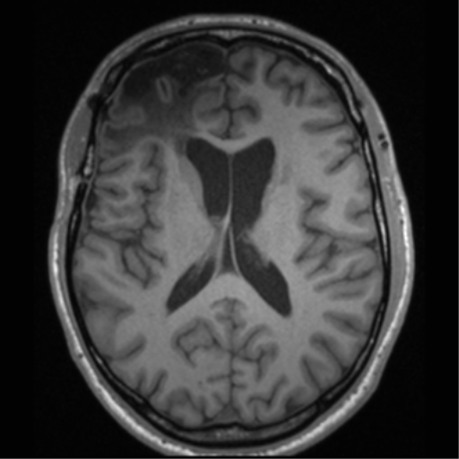 Cerebral hemorrhagic contusions- temporal evolution (Radiopaedia 40224-42757 Axial T1 44).png