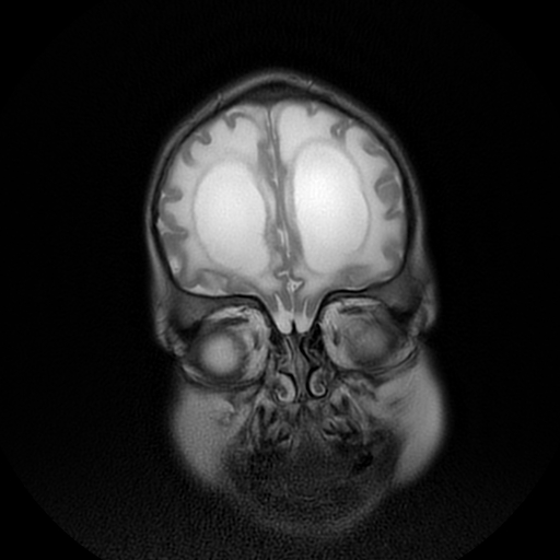 File:Cerebral manifestations of mucopolysaccharidosis type I (Radiopaedia 59171-66487 Coronal T2 2).jpg