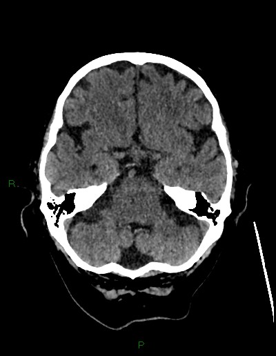 File:Cerebral metastases - ependymal and parenchymal (Radiopaedia 79877-93131 Axial non-contrast 18).jpg