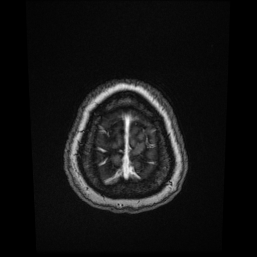 File:Cerebral metastases - melanoma (Radiopaedia 80972-94522 Axial T1 C+ 85).jpg