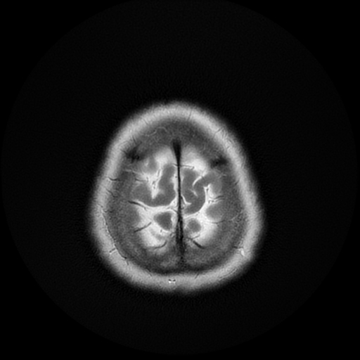 File:Cerebral metastases - melanoma (Radiopaedia 80972-94522 Axial T2 28).jpg