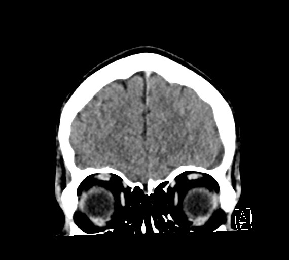 Cerebral metastases - testicular choriocarcinoma (Radiopaedia 84486-99855 D 13).jpg