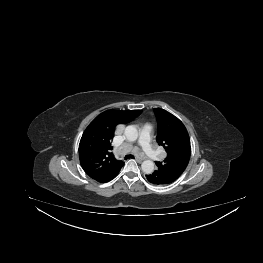 File:Cerebral metastases from lung cancer with amyloid angiopathy and cerebellopontine angle meningioma (Radiopaedia 74306-85223 A 24).jpg
