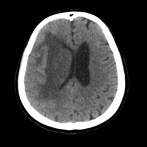 Cerebral metastasis to basal ganglia (Radiopaedia 81568-95412 Axial non-contrast 41).png