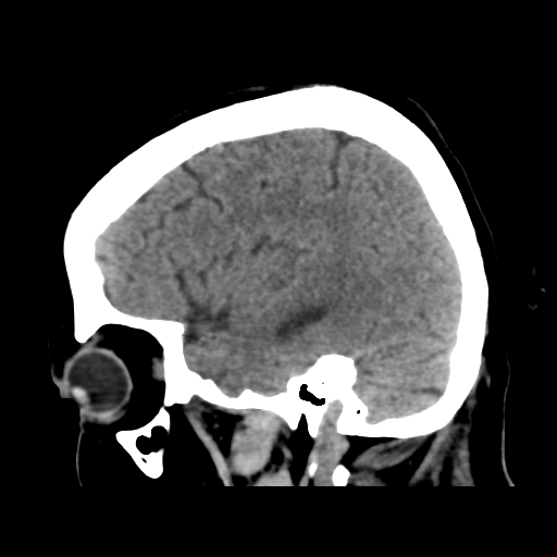 Cerebral metastasis to basal ganglia (Radiopaedia 81568-95412 E 45).png