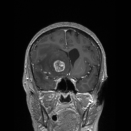 File:Cerebral metastasis to basal ganglia (Radiopaedia 81568-95413 Coronal T1 C+ 38).png