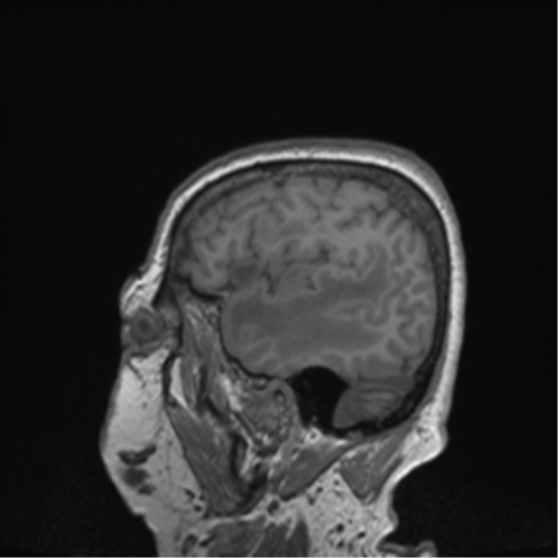 Cerebral metastasis to basal ganglia (Radiopaedia 81568-95413 Sagittal T1 64).png