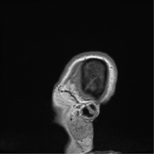 Cerebral metastasis to basal ganglia (Radiopaedia 81568-95413 Sagittal T1 76).png