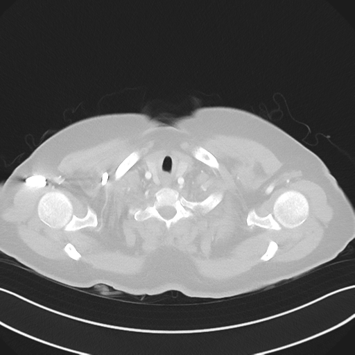 File:Cerebral metastasis to basal ganglia (Radiopaedia 81568-95414 Axial lung window 3).png