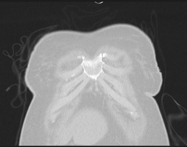 File:Cerebral metastasis to basal ganglia (Radiopaedia 81568-95414 Coronal lung window 12).png