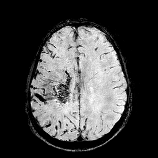 Cerebral parenchymal arteriovenous malformation (Radiopaedia 27280-27456 Axial SWI 79).jpg