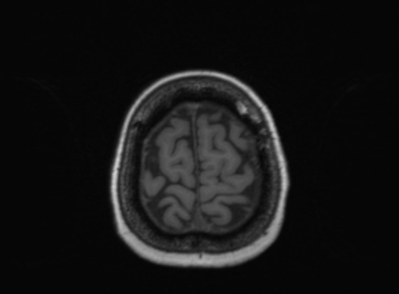 Cerebral ring enhancing lesions - cerebral metastases (Radiopaedia 44922-48817 Axial T1 121).jpg