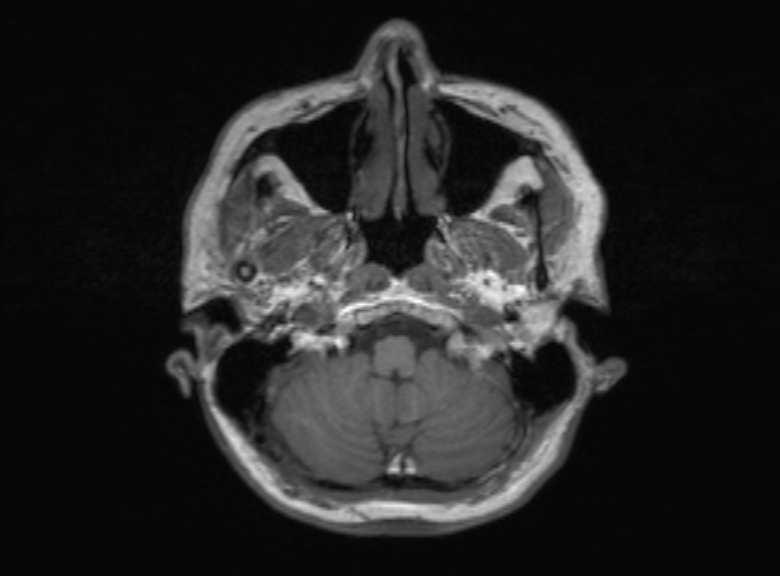 Cerebral ring enhancing lesions - cerebral metastases (Radiopaedia 44922-48817 Axial T1 335).jpg