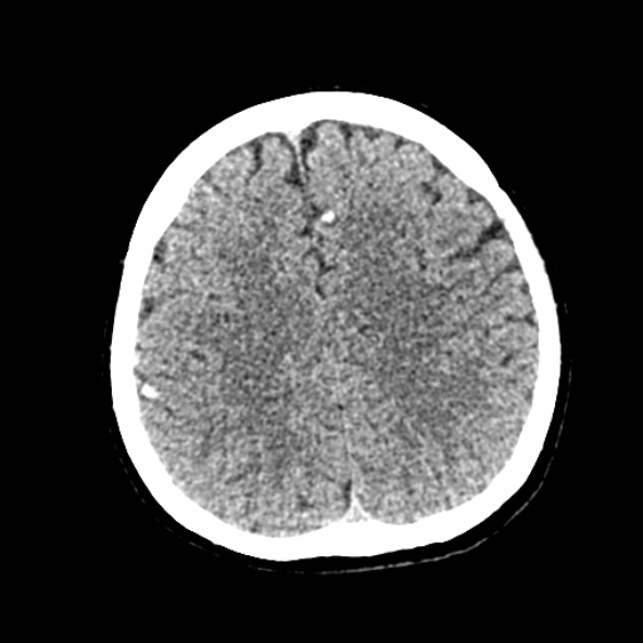 Cerebral ring enhancing lesions - cerebral metastases (Radiopaedia 44922-48818 Axial non-contrast 65).jpg