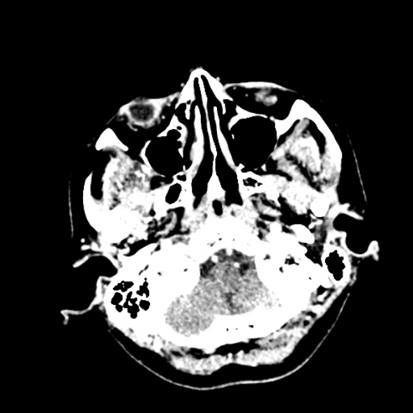 Cerebral ring enhancing lesions - cerebral metastases (Radiopaedia 44922-48818 B 39).jpg