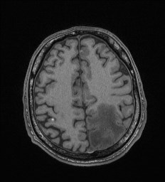 Cerebral toxoplasmosis (Radiopaedia 43956-47461 Axial T1 59).jpg