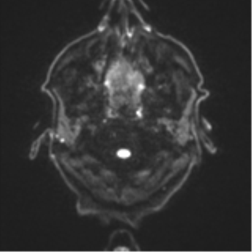 Cerebral toxoplasmosis (Radiopaedia 54575-60804 Axial DWI 35).png