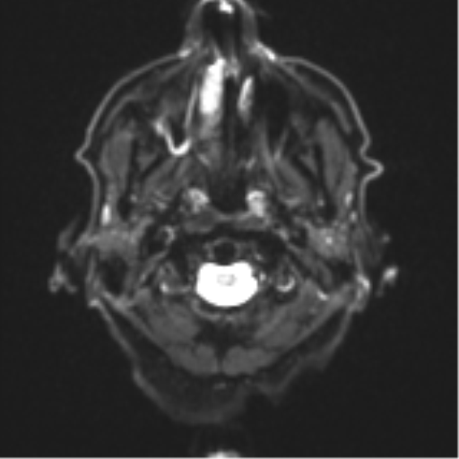File:Cerebral toxoplasmosis (Radiopaedia 54575-60804 Axial DWI 4).png