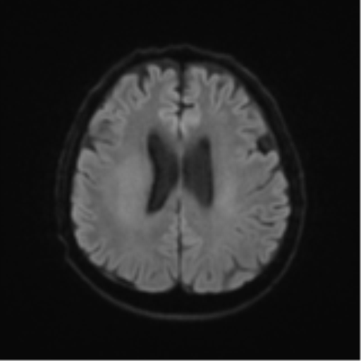 File:Cerebral toxoplasmosis (Radiopaedia 54575-60804 Axial DWI 54).png