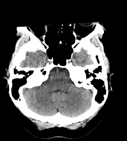 File:Cerebral venous infarction due to transverse sinus thrombosis (Radiopaedia 34688-36116 Axial non-contrast 6).png