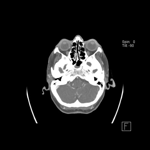 Cerebral venous infarction with hemorrhage (Radiopaedia 65343-74396 A 18).jpg