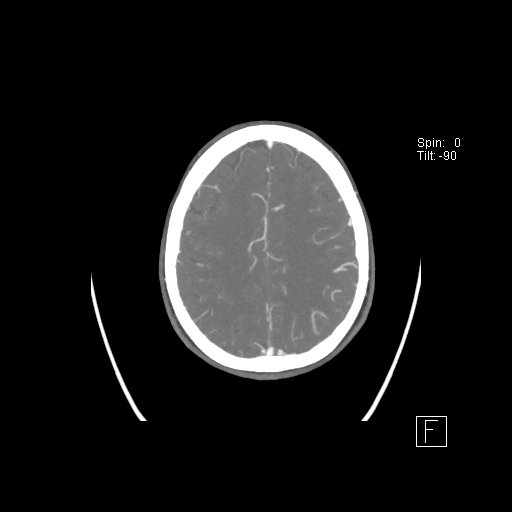 Cerebral venous infarction with hemorrhage (Radiopaedia 65343-74396 A 98).jpg