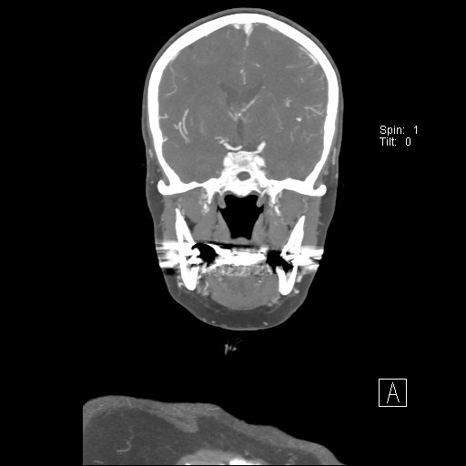 Cerebral venous infarction with hemorrhage (Radiopaedia 65343-74396 B 141).jpg