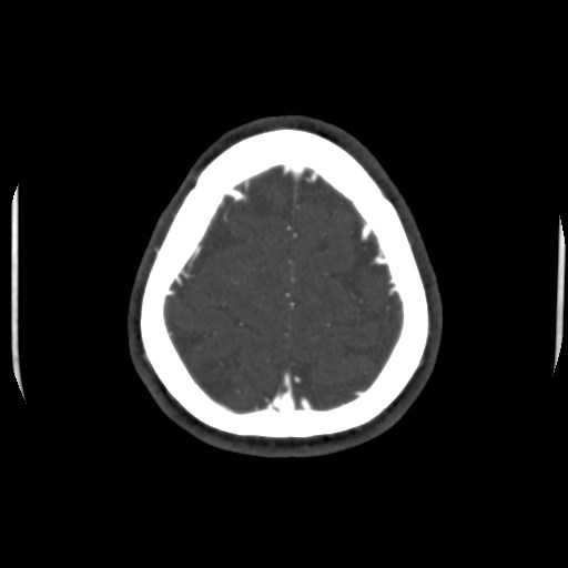 Cerebral venous sinus thrombosis (Radiopaedia 40619-43227 A 201).jpg